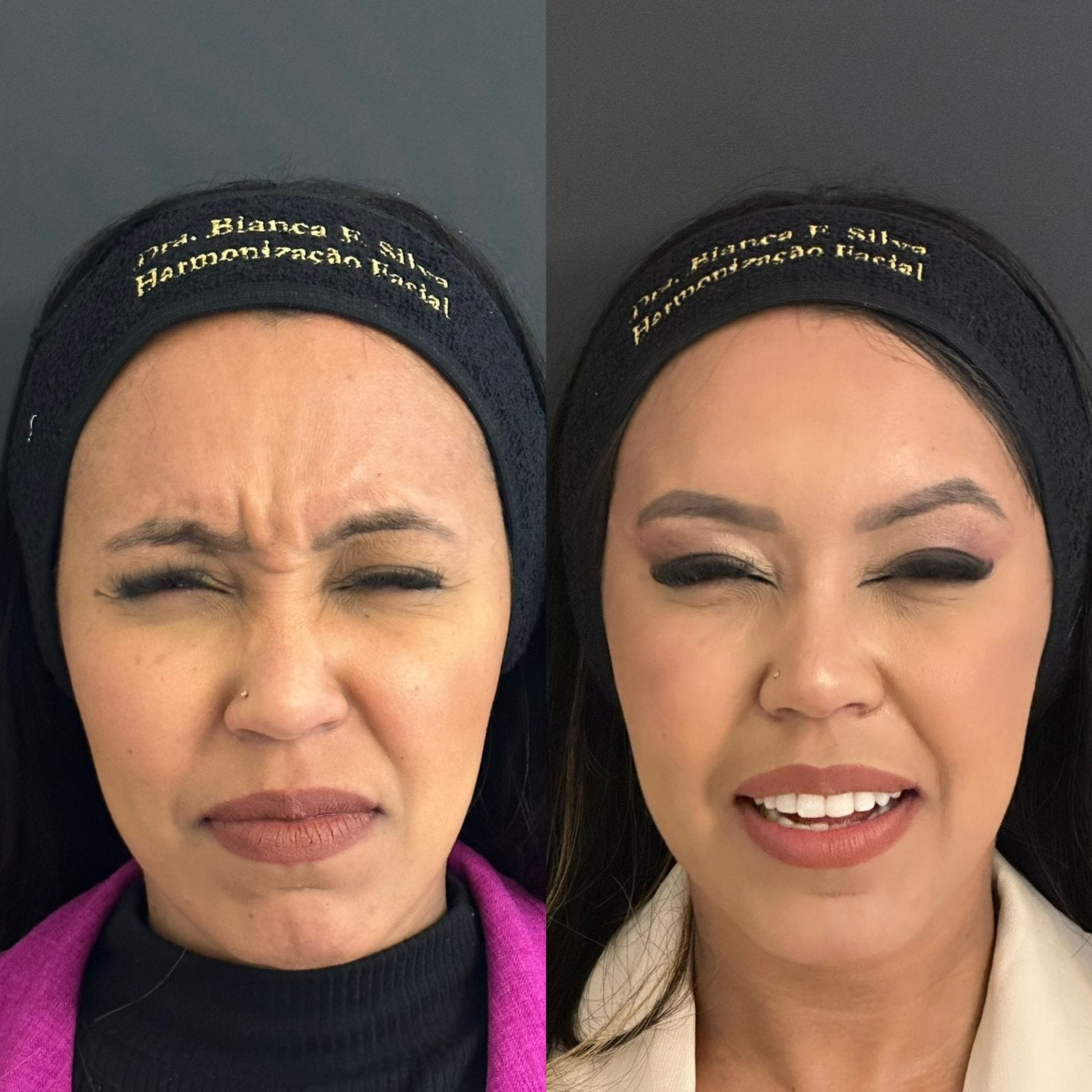Tratamento para suavizar a ruga da glabela, conhecida como ruga do bravo.