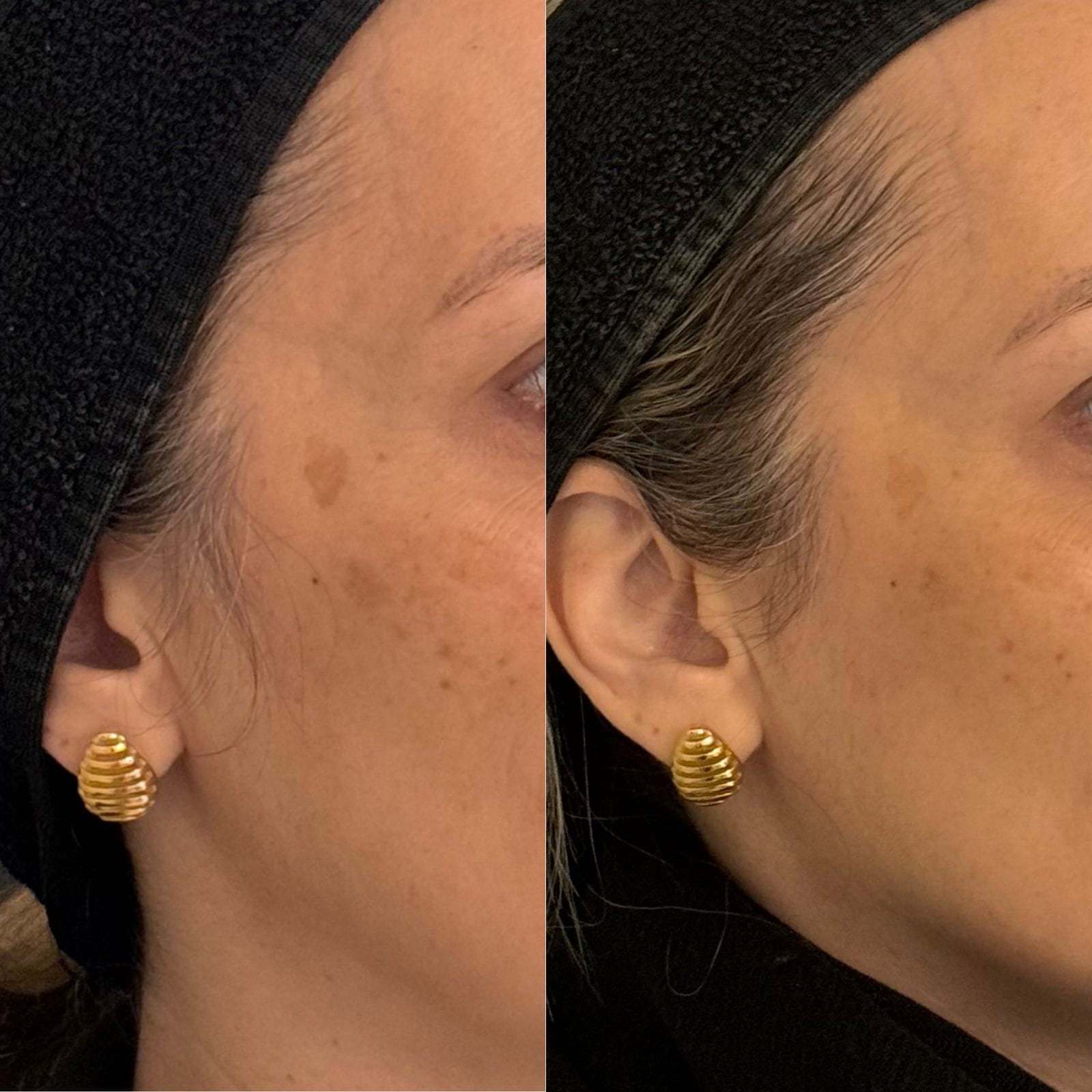 Antes e depois do tratamento com Lavieen para melasma, mostrando a melhora na uniformização da pele.