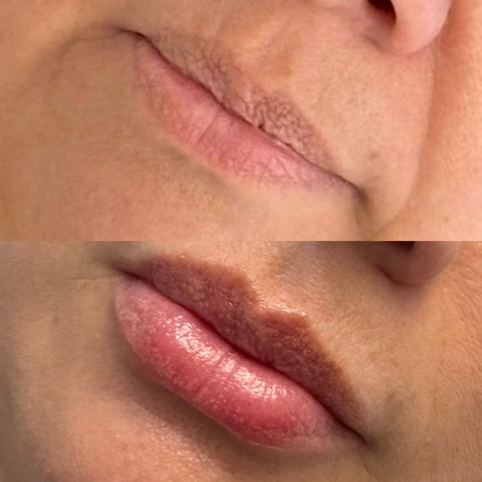 Antes e depois do preenchimento labial, destacando aumento de volume e contorno nos lábios.