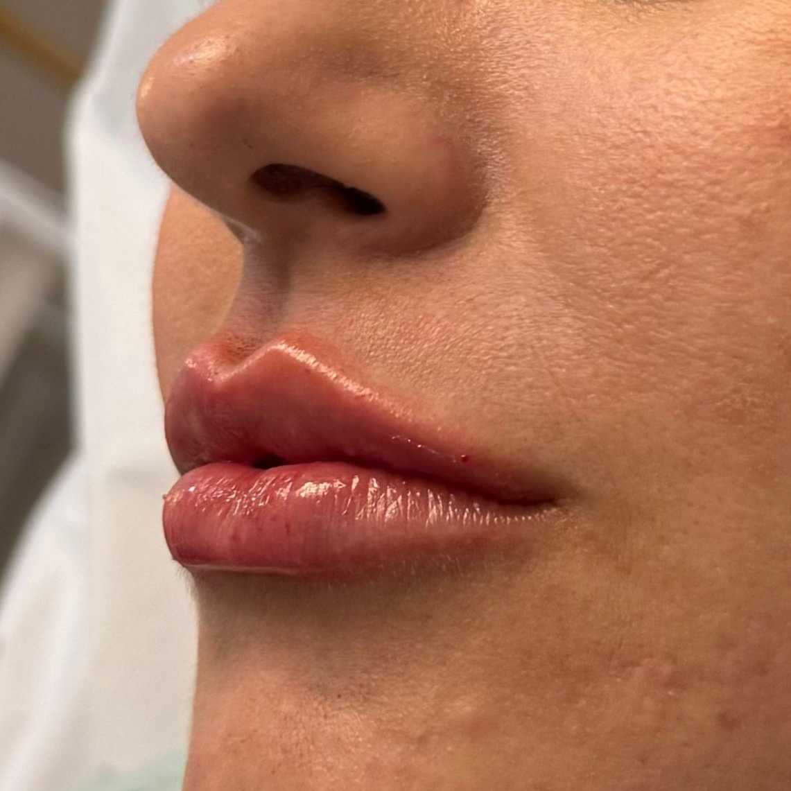 Resultado do preenchimento labial, com aumento de volume e contorno, destacando lábios mais definidos e naturais.