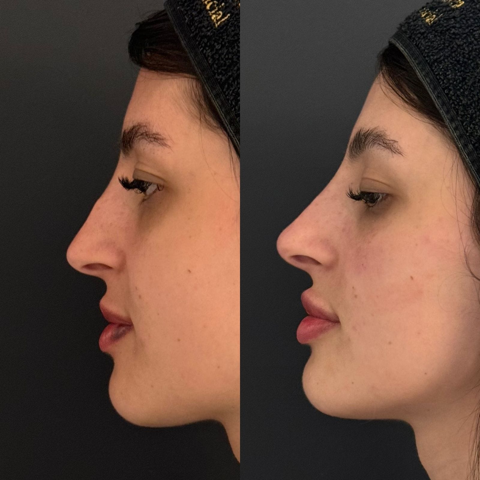 Antes e depois da rinomodelação, mostrando a melhora na forma e proporção do nariz, sem cirurgia.