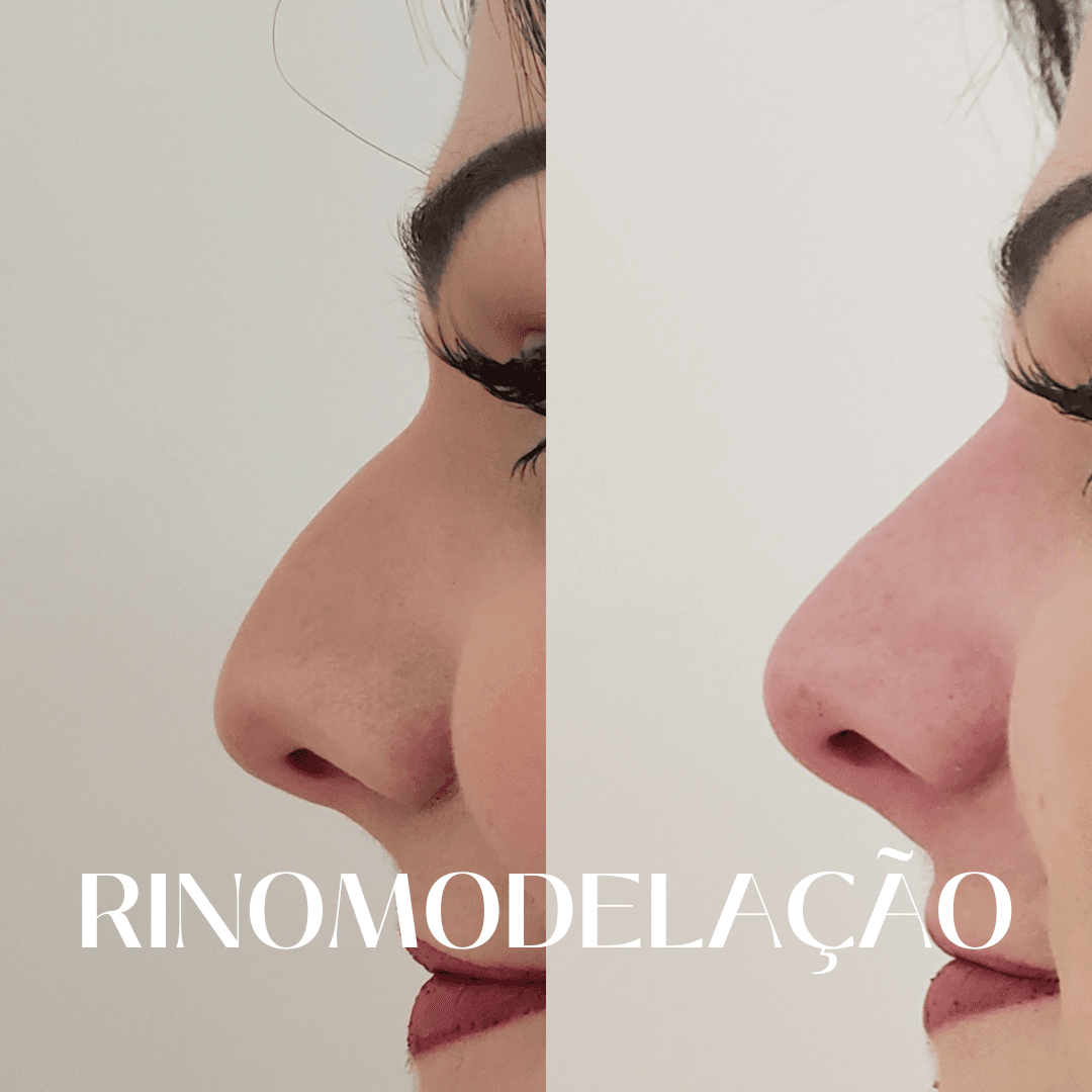 Resultado da rinomodelação, corrigindo e arrebitando a ponta do nariz, proporcionando harmonia facial.