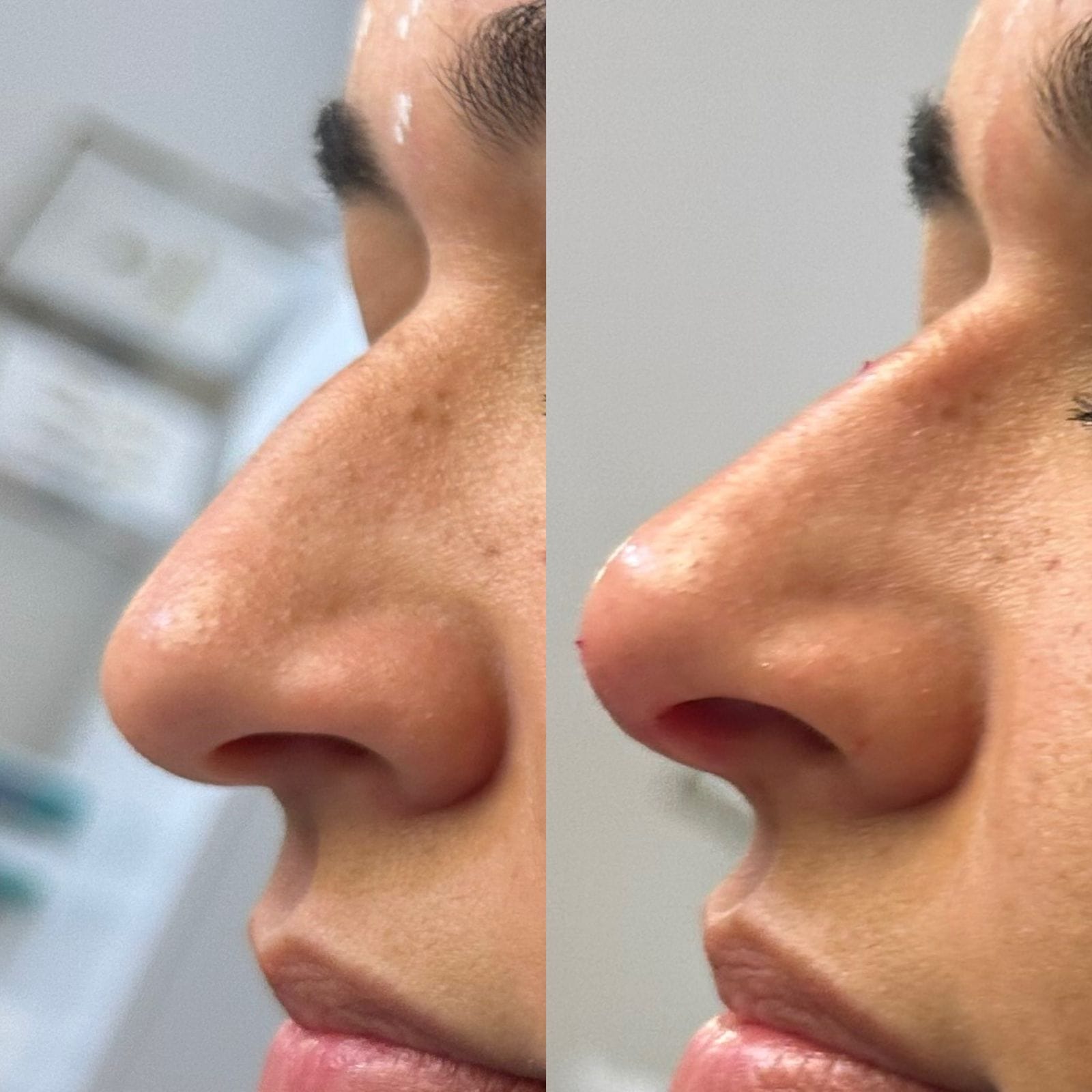 Resultado da rinomodelação, corrigindo a corcova nasal e proporcionando um perfil mais harmonioso.