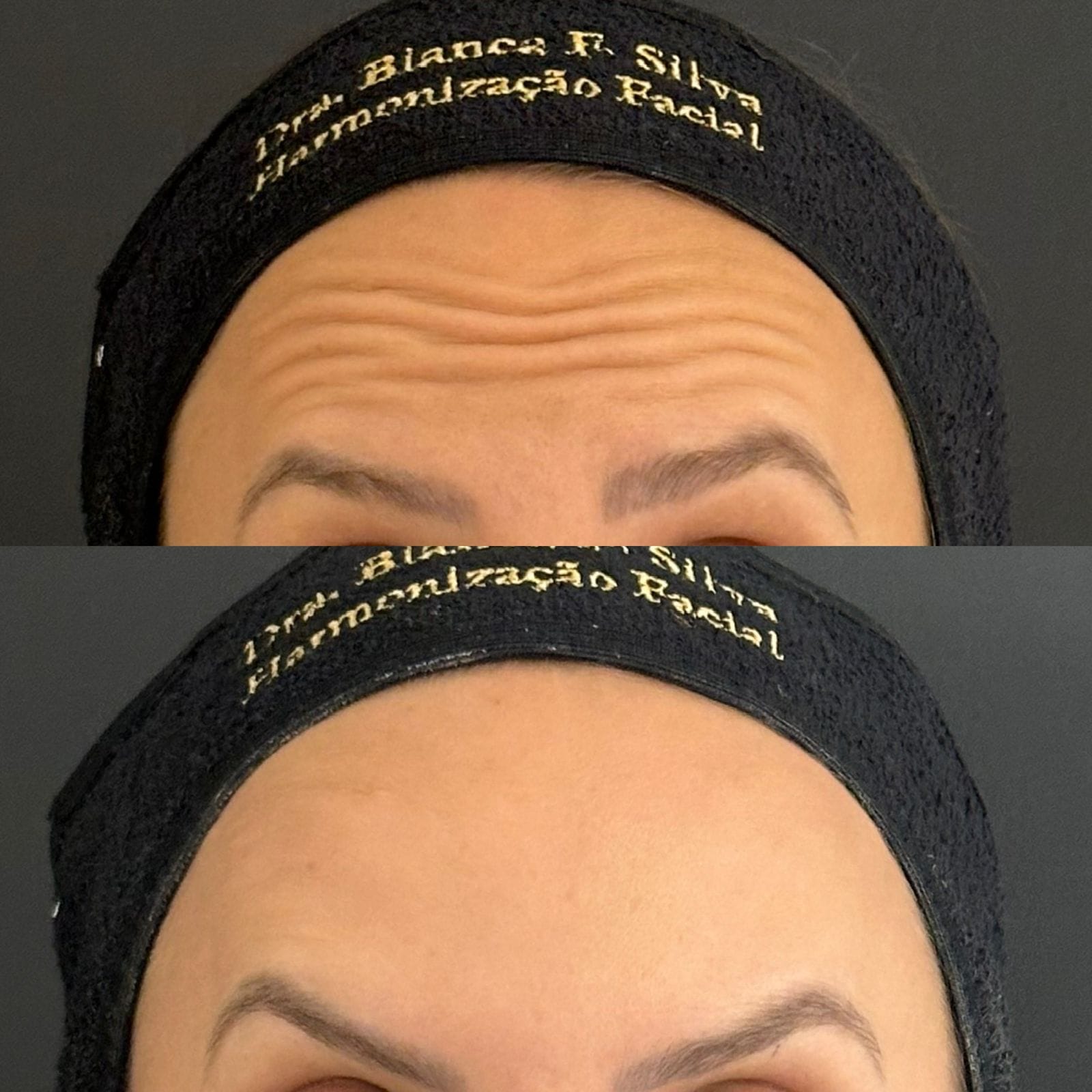 Antes e depois do tratamento de suavização das linhas de expressão na região da testa, com cuidados faciais avançados, oferecendo um aspecto mais relaxado e rejuvenescido.