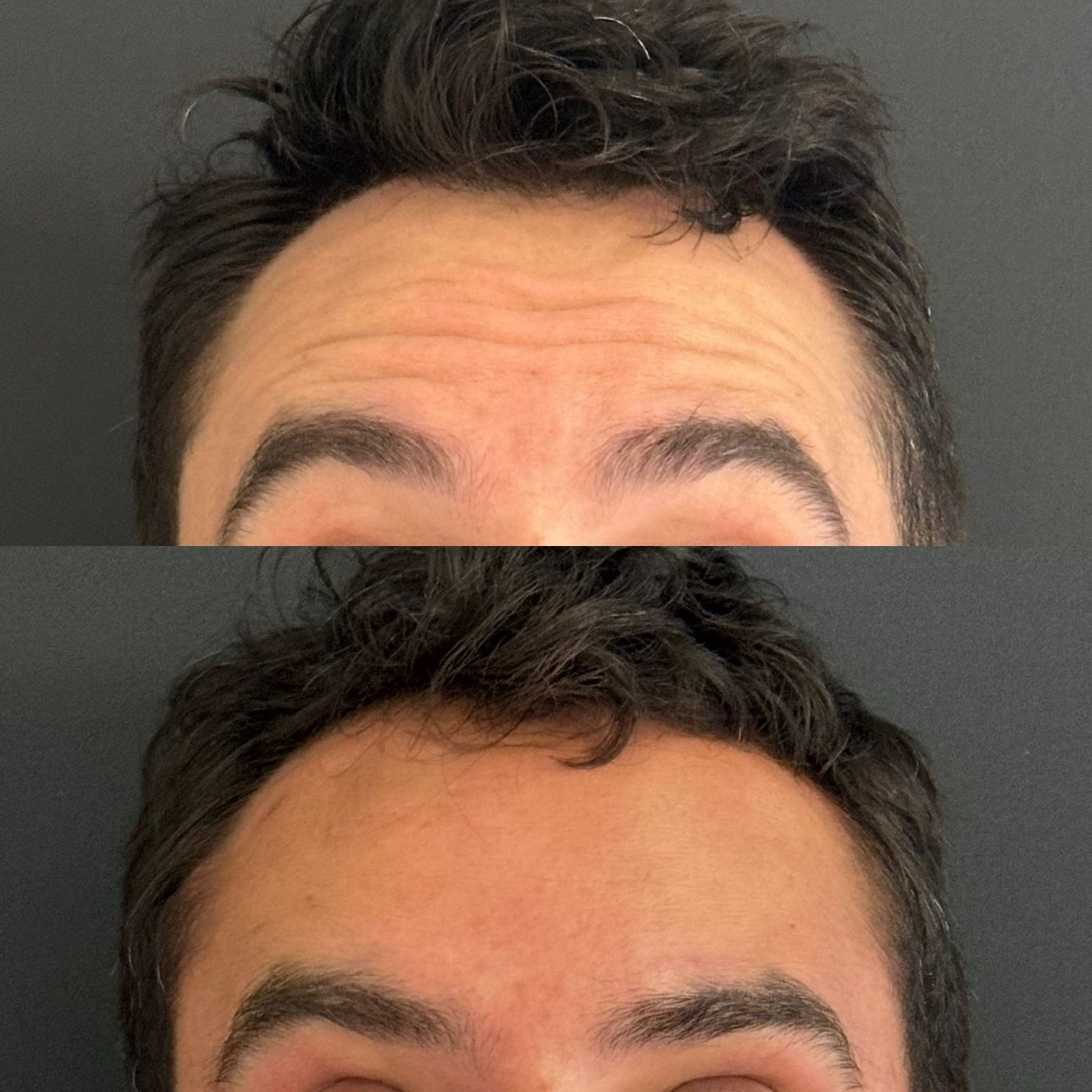 Antes e depois da suavização das linhas de expressão na testa, proporcionando um resultado natural e uma pele mais uniforme.