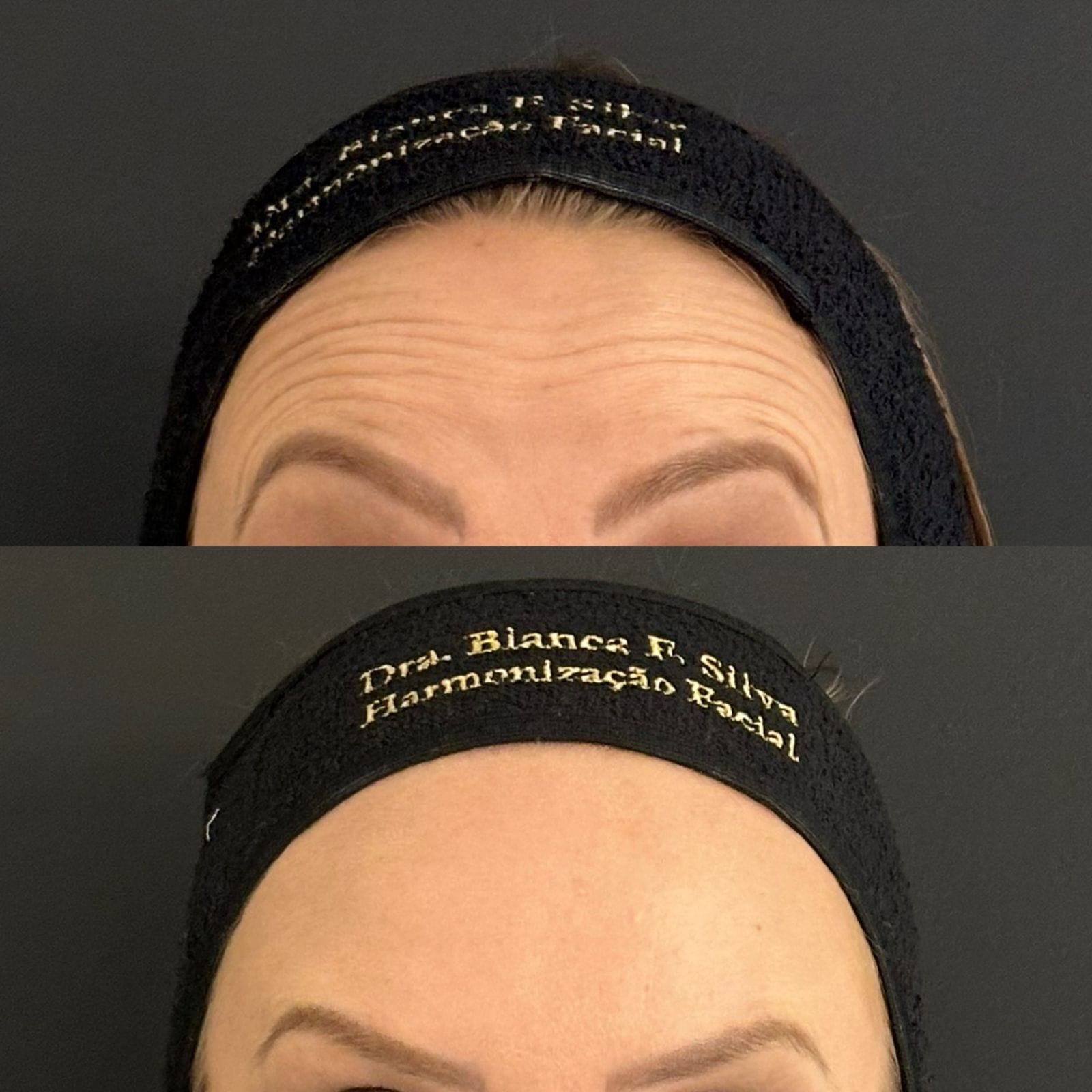 Antes e depois do tratamento de rejuvenescimento facial, focado na testa, com resultados visíveis de suavização das linhas de expressão e um visual mais relaxado.