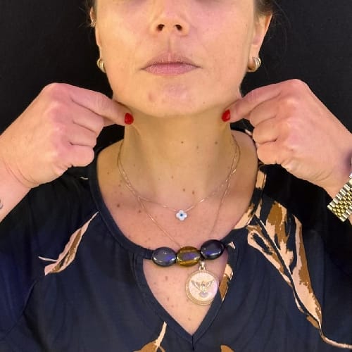 Antes e depois do tratamento de bioestímulo de colágeno na região do pescoço, proporcionando firmeza e rejuvenescimento.