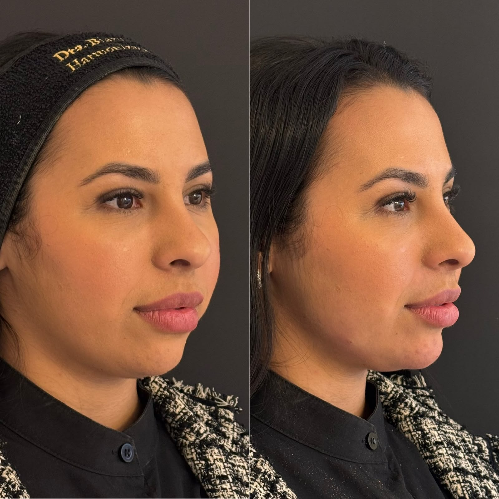Antes e depois de harmonização facial com foco em alinhamento de perfil e projeção do terço inferior para equilíbrio estético.