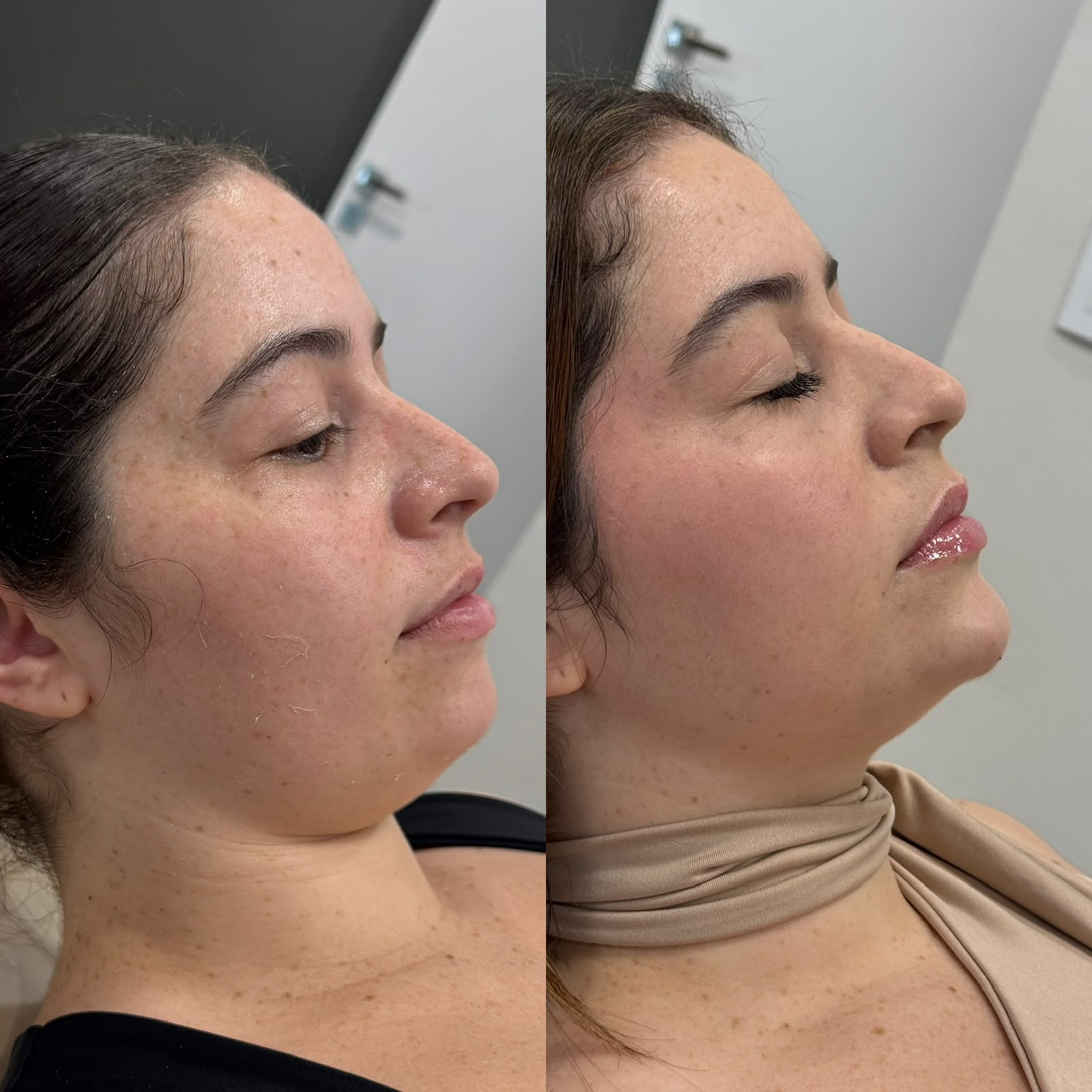 Antes e depois de harmonização facial com foco em definição de contorno inferior e preenchimento para volume labial natural.