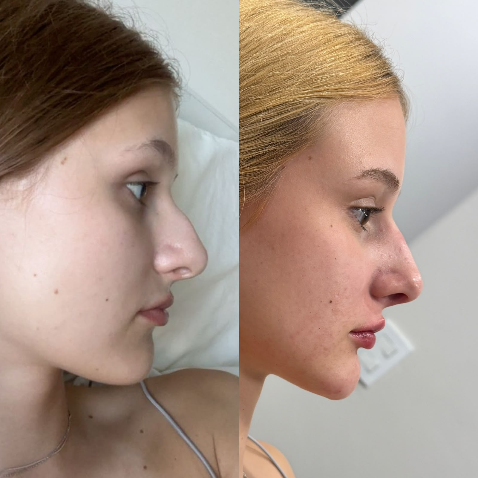 Antes e depois de harmonização do perfil facial com nivelamento do dorso nasal e preenchimento labial sutil.