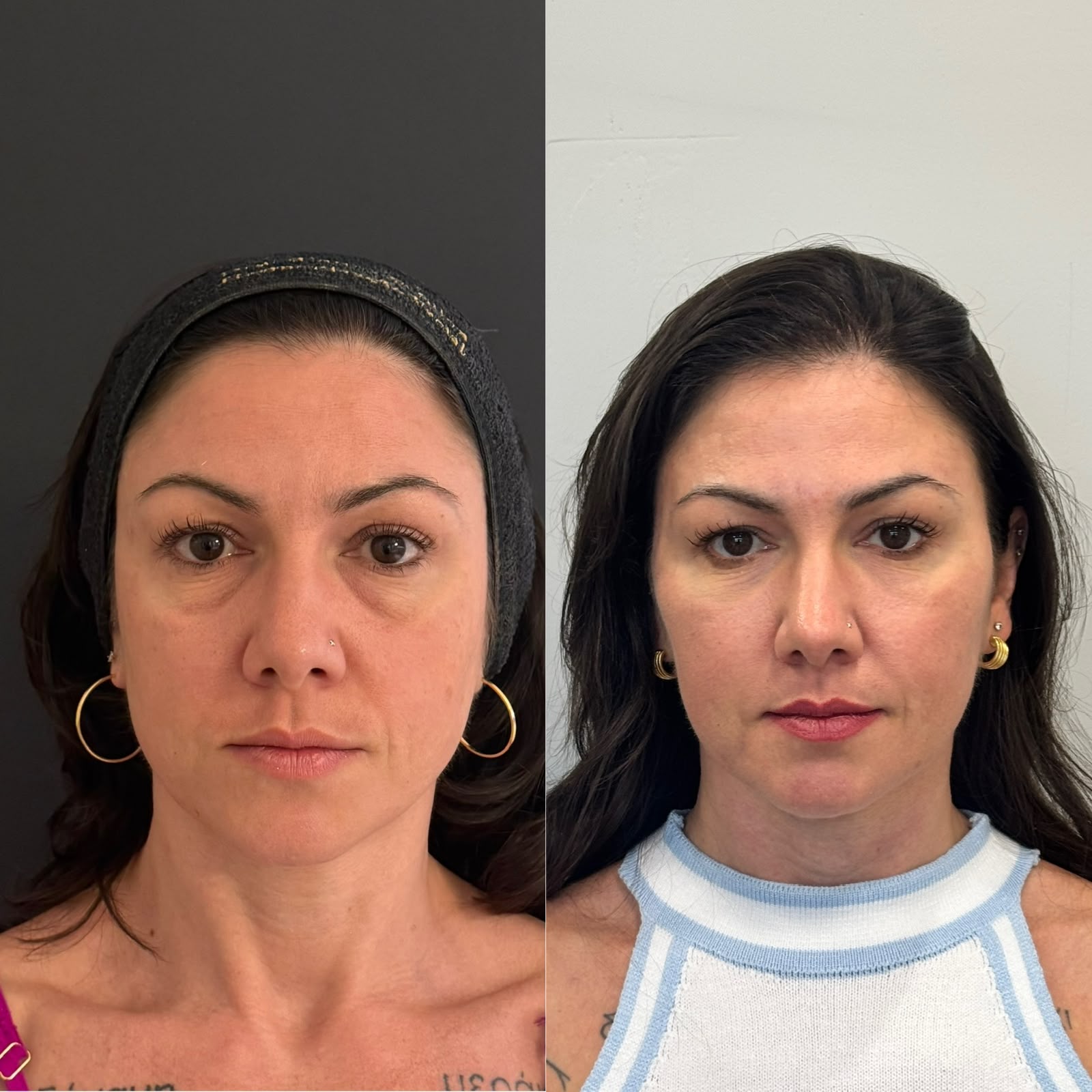 Antes e depois de harmonização facial com foco em preenchimento de olheiras e suavização da calha lacrimal para um olhar descansado.