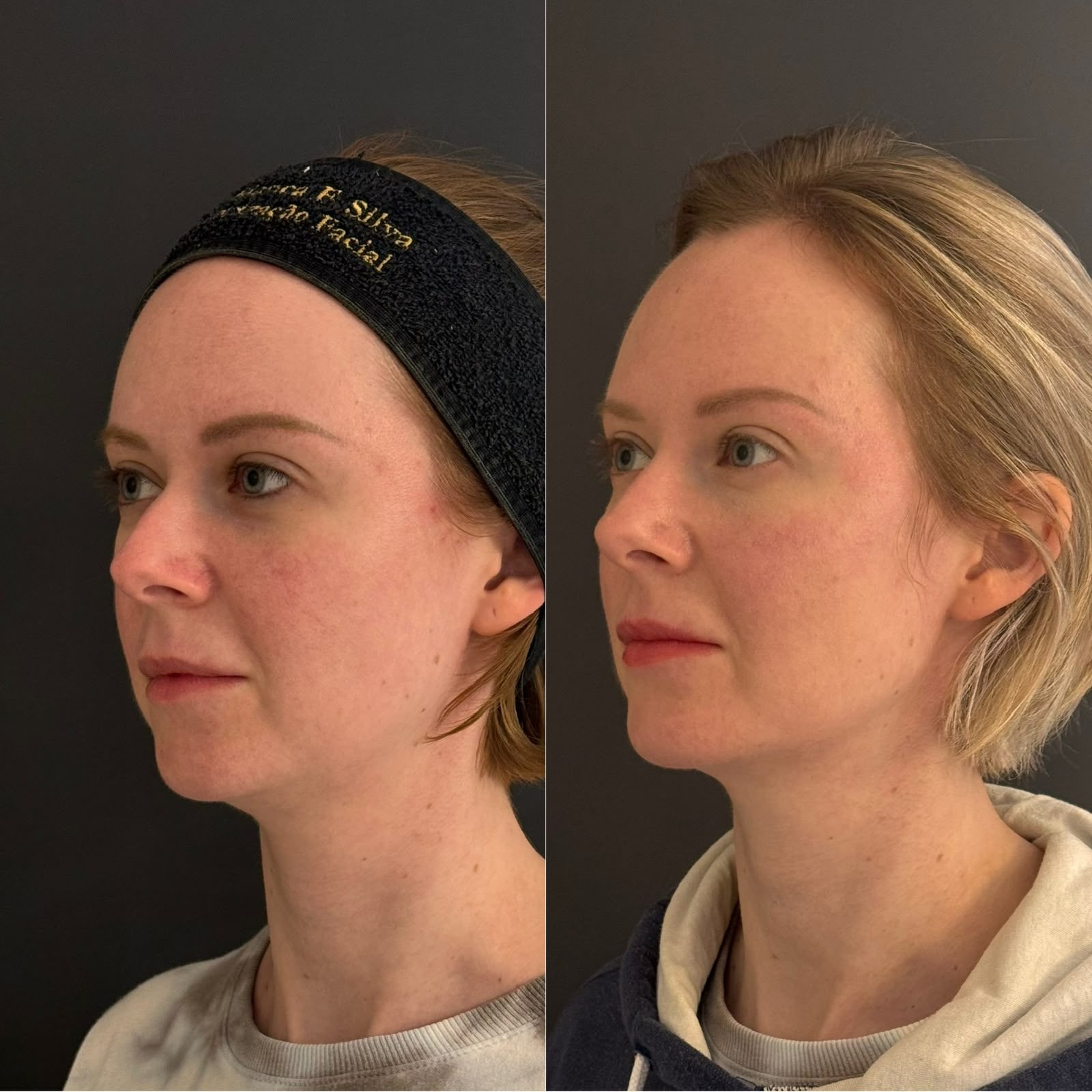 ntes e depois de harmonização facial preventiva com bioestimulador de colágeno para manutenção da firmeza e contorno facial.