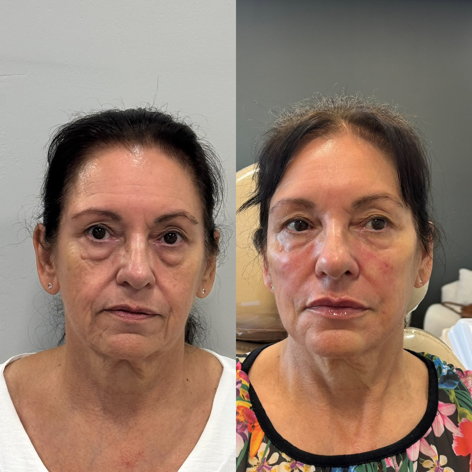 Antes e depois de harmonização facial em pele madura para suavização de olheiras profundas e sustentação do terço médio do rosto.