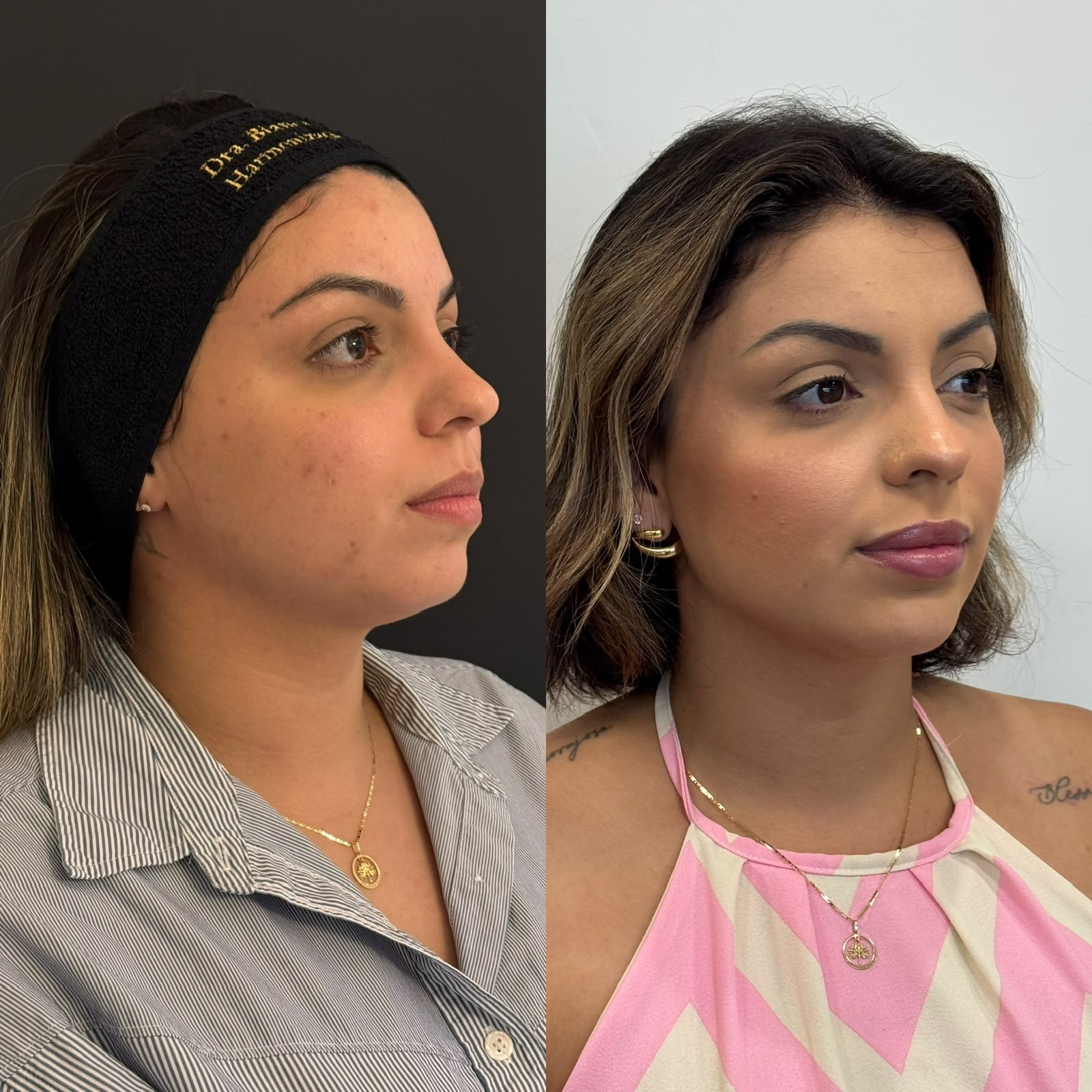 Antes e depois de harmonização facial com projeção de perfil e definição do contorno para uma expressão mais madura e elegante.