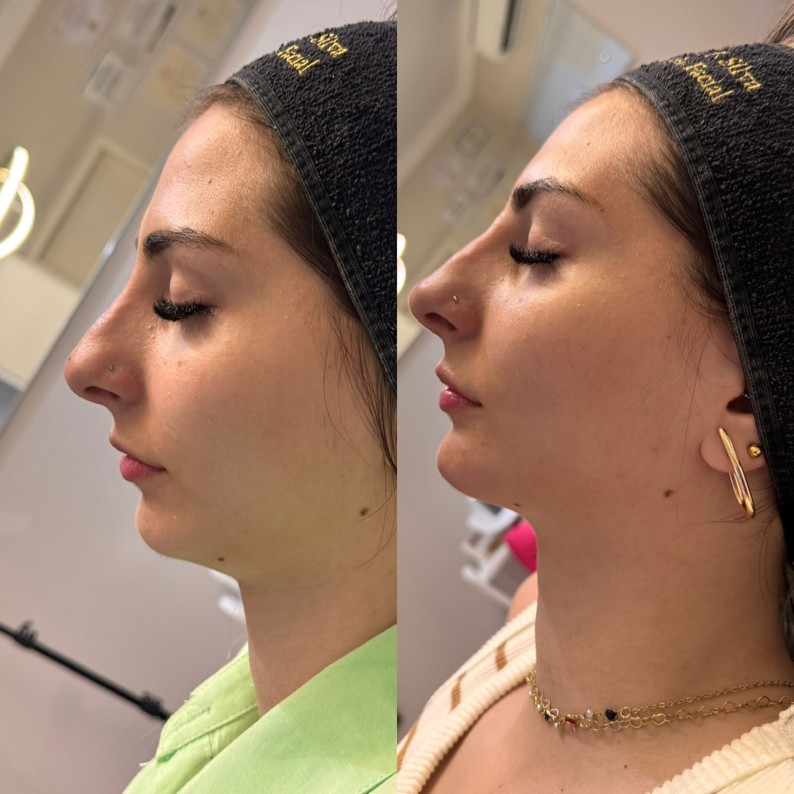 Antes e depois de harmonização do perfil facial com foco em projeção de queixo e modelagem sutil do nariz para equilíbrio das proporções.
