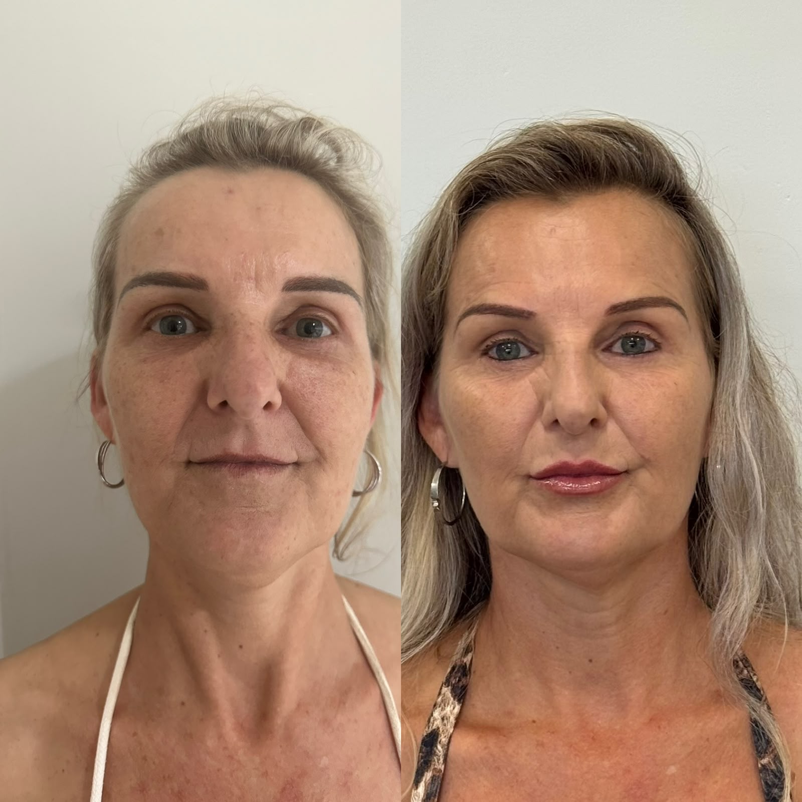Antes e depois de rejuvenescimento facial global em pele madura com preenchimento de sulcos e realce de contornoxx