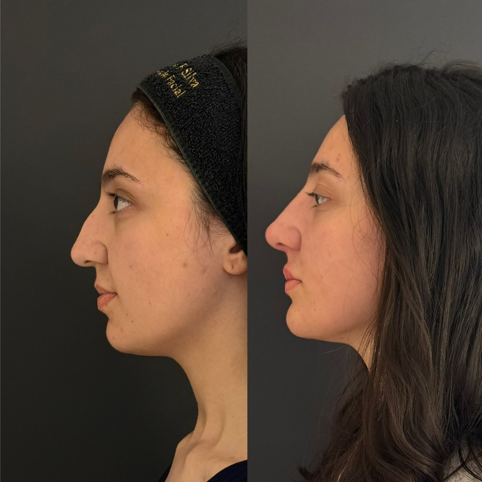 Antes e depois de rinomodelação para nivelamento do dorso nasal e elevação da ponta do nariz com resultados naturais.